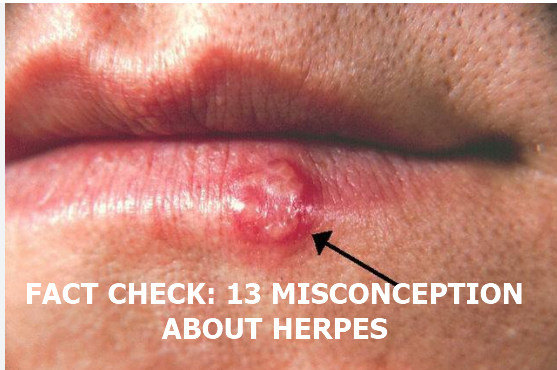 Fact Check: 13 Common Misconceptions About Herpes